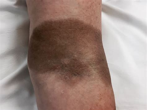 Haemosiderin pigmentation after intravenous iron infusion | The BMJ