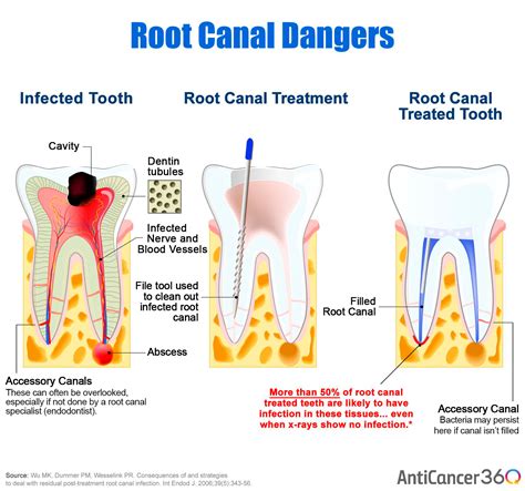 What You Need To Know About Root Canals And Cancer (Science)