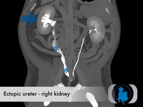 Ectopic Ureter