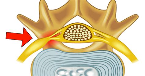 Foraminal Stenosis - Atlanta, GA - Spine Surgery