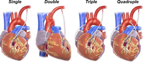 triple bypass surgery - Zollatry