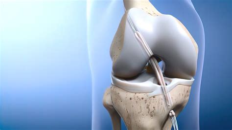 Individualized ACL Reconstruction Surgery - 3 Best Grafts | Baton Rouge, LA