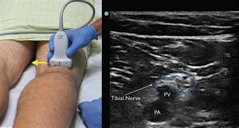 How to Perform Ultrasound-Guided Distal Sciatic Nerve Block in the ...