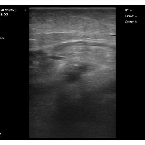 Ultrasound visualization of right superficial femoral artery and right... | Download Scientific ...