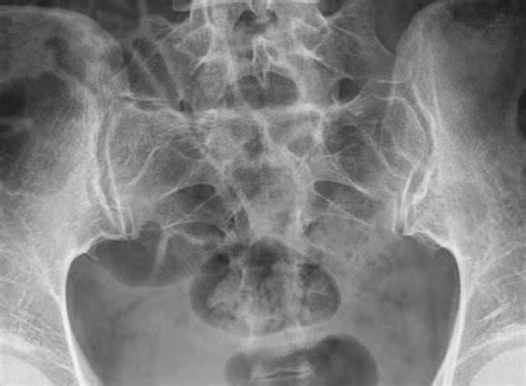 Fractured Sacrum - Fracture Treatment