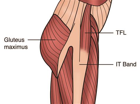 Tensor Fascia Latae Dysfunction and Sciatica