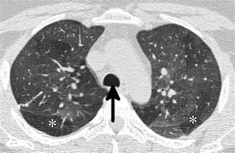 Mosaic Attenuation: Etiology, Methods of Differentiation, and Pitfalls | RadioGraphics