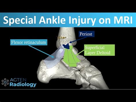 Torn Deltoid Ligament