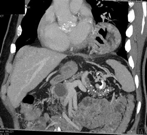 Gastric Volvulus - Stomach Case Studies - CTisus CT Scanning