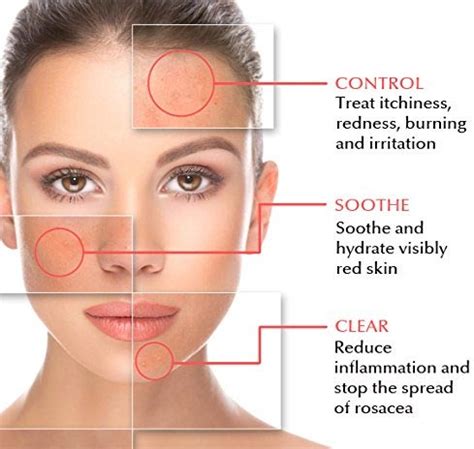 Rosacea Natural Treatment · Top Dermatology · Dermatologist NYC