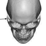 zygomatic arch anatomy 3D Ct scan top view Dr Barry Eppley Indianapolis - Explore Plastic Surgery