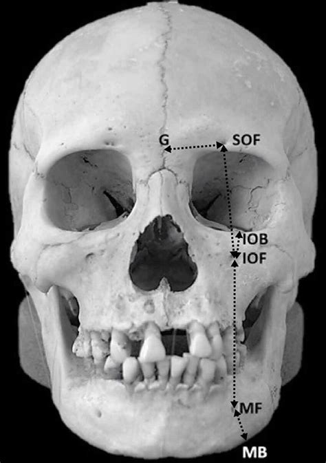 Parameters of supraorbital, infraorbital and mental foramina; G ...