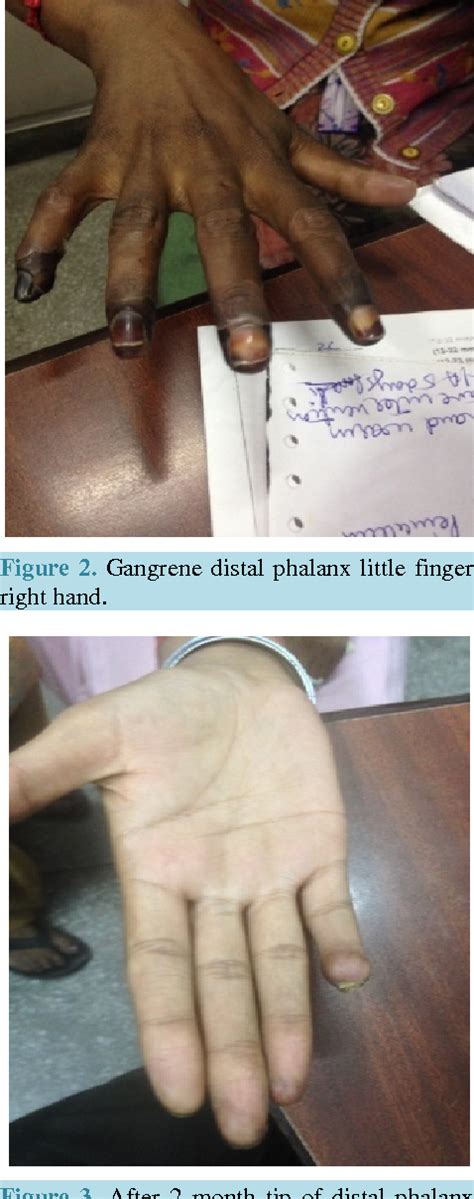 Figure 1 from Accidental Intra-Arterial Injection during Test Dose of ...