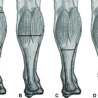 Levels of lengthening for common gastrocnemius recession techniques ...