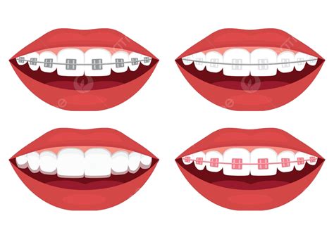 Types Of Braces For Teeth Alignment Metal Ceramic Plastic Ligature And ...