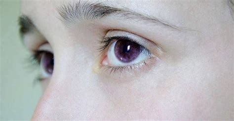 Datos Médicos on Twitter | Violet eyes, Purple eyes, Eyes