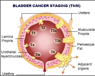 Urology 1: Hematuria and Bladder Cancer Flashcards | Quizlet