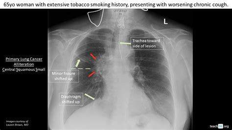 Hilar Mass - Primary Lung Cancer - teachIM