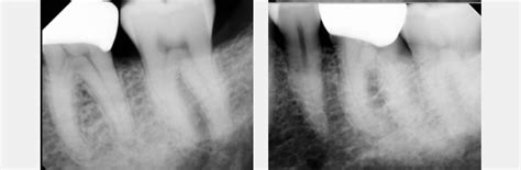 Identifying Pulpal Necrosis for Endodontic Treatment - Spear Education