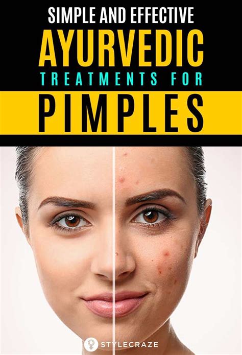 10 Best Ayurvedic Tips And Remedies For Acne-Free Clear Skin | Pimple treatment, Pimples ...