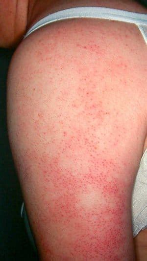 Understanding Bumpy "Chicken" Skin — Keratosis Pilaris - Zel Skin & Laser Specialists - now ...