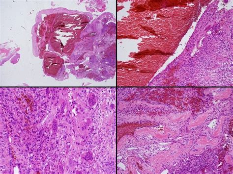 Aneurysmal bone cyst - wikidoc