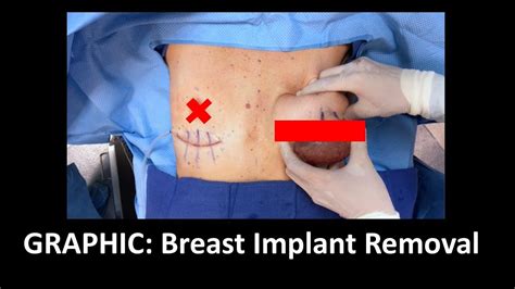 GRAPHIC: En Bloc Capsulectomy Implant Removal w/ Explanation - YouTube