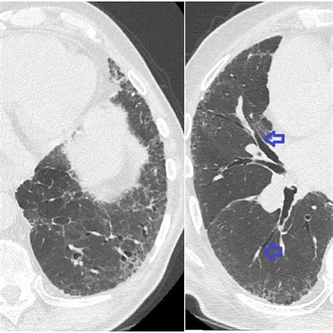 CT Interstitial pattern ( honeycombing mild bronchiectasis). | Download Scientific Diagram