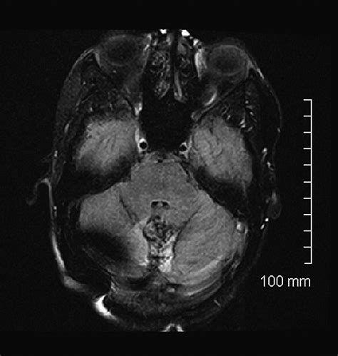 Infarction: Cerebellar Infarct Treatment