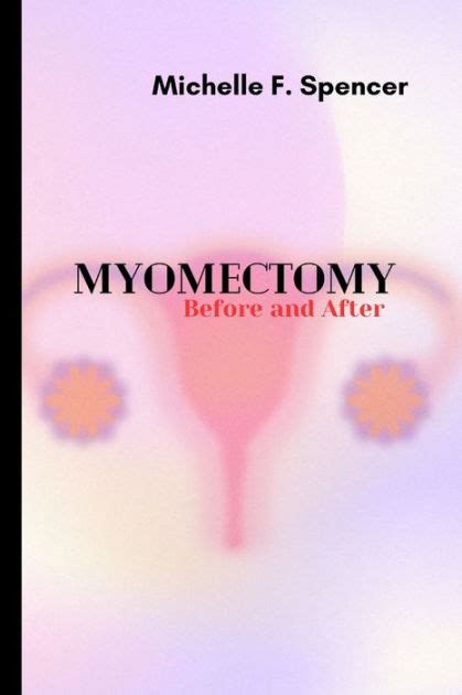 Myomectomy, before and after by Michelle F. Spencer, Paperback | Barnes & Noble®