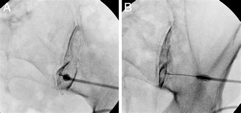 Use of Diagnostic Injections to Evaluate Sacroiliac Joint Pain | International Journal of Spine ...