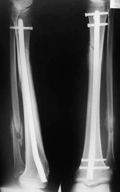 Postoperative X-rays of tibial fracture. Shows the use of standard... | Download Scientific Diagram