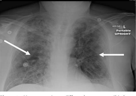 [PDF] Idiopathic Acute Eosinophilic Pneumonia: An Uncommon Cause of ...