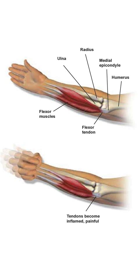 Medial Epicondylitis