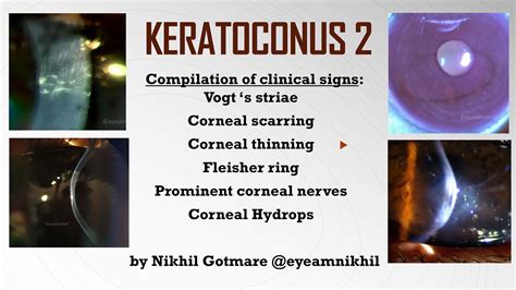 Keratoconus (Part 2): Compilation of clinical signs- Vogt's striae, Fleischer ring, Hydrops etc ...