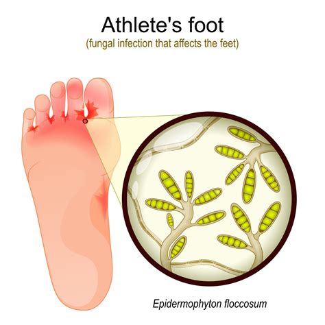 ATTDX AthletesFoot FungusRelief TreatmentSpray - Wizzgoo