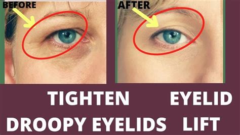 Lift Droopy Eyelids | Exercises and Massage | Droopy eyelids, Eyelid lift, Face yoga facial ...