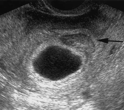 Blighted Ovum: Leading Cause of Early Miscarriage