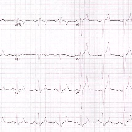 ECG showing tall and tented T waves. | Download Scientific Diagram