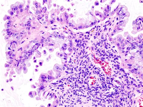 File:Mucinous borderline tumor of ovary (2) histopatholgy.jpg - Wikimedia Commons