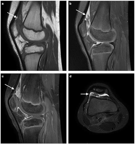 Focal Synovitis Knee Mri | My XXX Hot Girl