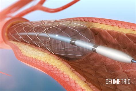 Atherosclerosis Animation | Geometric Medical