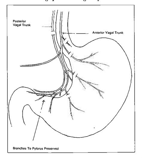 Figure 1 from LAPAROSCOPIC POSTERIOR TRUNCAL VAGOTOMY AND ANTERIOR HIGHLY SELECTIVE VAGOTOMY-A ...