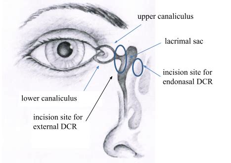 Treatment of acquired nasolacrimal duct obstruction | Ida-Tallinna Keskhaigla