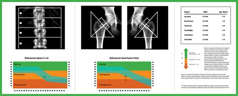 Bone Density Scan Results / Bone densitometry - The more bone material a person has in their ...