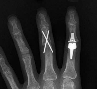 Osteoarthritis in the hand and wrist | Plastic Surgery Key