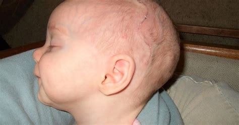 Scaphocephaly: What is it? Symptoms, Causes, Diagnosis and Treatment - Scope Heal