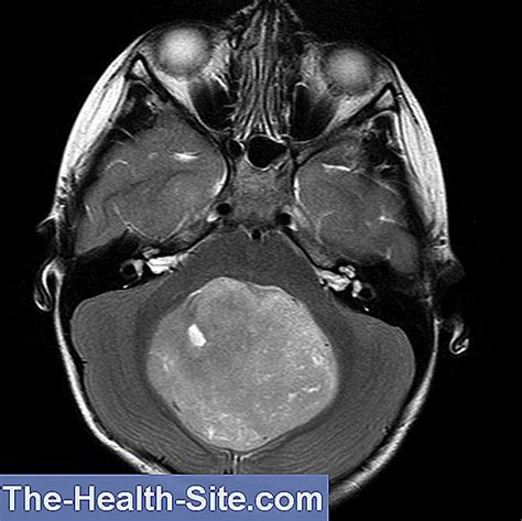 Medulloblastoma: Causes, Symptoms, Treatment 💊 Scientific-Practical Medical Journal - 2024