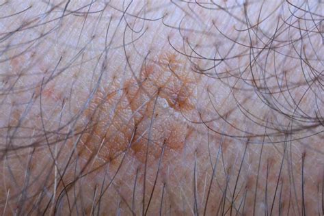 Seborrheic Keratosis (Skin Barnacles): Pictures, Cause, Removal