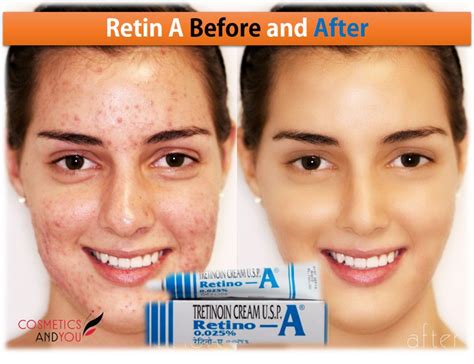 Retin A Before and After – Cosmetics and you : Acne Treatment, Careprost Eyelashes, Careprost ...